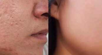 Pimples : ఈ పేస్ట్ రాసుకుంటే ముఖంపై మొటిమ‌లు, మ‌చ్చ‌లు, గుంత‌లు పోతాయి..!