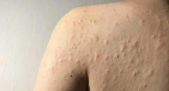 Skin Allergy : స్కిన్ ఎలర్జీలని ఇలా సులభంగా తగ్గించుకోవచ్చు..!