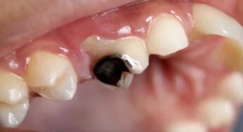 Tooth Decay : రోజూ దీన్ని కాసేపు న‌మ‌లండి చాలు.. పుచ్చు ప‌న్ను పోతుంది.. నొప్పి త‌గ్గుతుంది..!