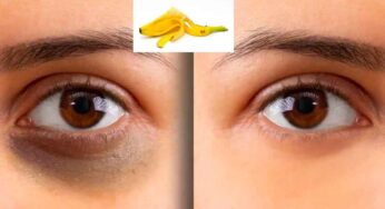 Banana Peel For Dark Circles : అర‌టిపండు తొక్క‌తో ఇలా చేయండి.. డార్క్ స‌ర్కిల్స్ మాయ‌మ‌వుతాయి..!