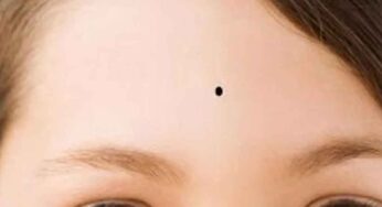 Birthmark On Forehead : ఈ భాగంలో పుట్టు మచ్చ ఉంటే ఆకస్మిక ధన లాభం..!