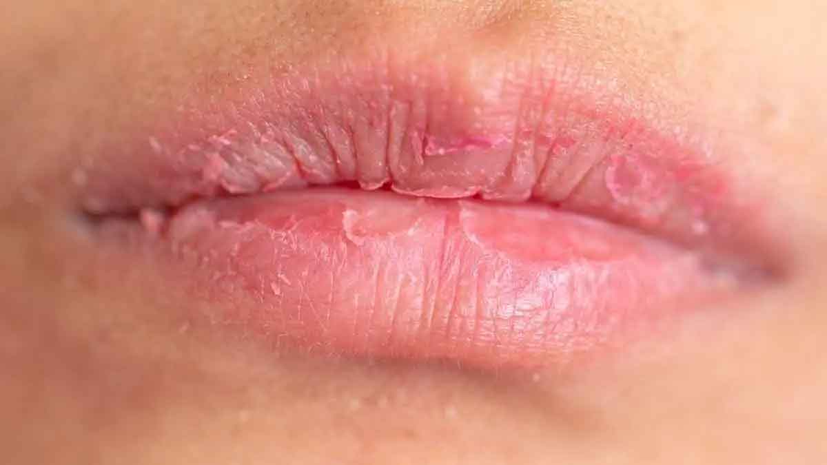 dry lips wonderful home remedies 