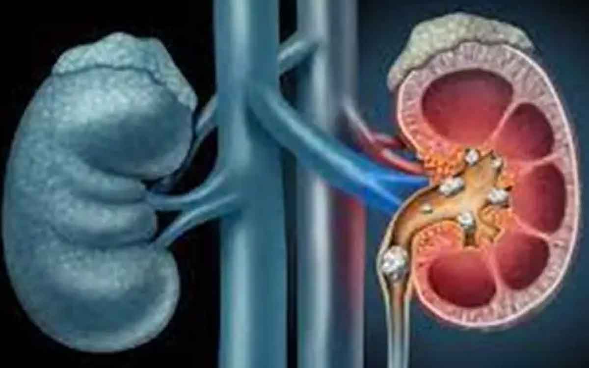 dissolve kidney stones with these natural remedies 