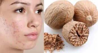 Pimples Home Remedies : మీ ముఖంపై ఉండే ఎలాంటి మ‌చ్చ‌లు అయినా స‌రే ఇలా చేస్తే పోతాయి..!