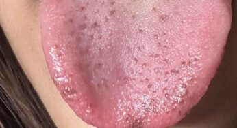 Black Marks On Tongue : మీ నాలుక‌పై ఇలా ఉందా.. అయితే అప్ర‌మ‌త్తంగా ఉండాల్సిందే..!