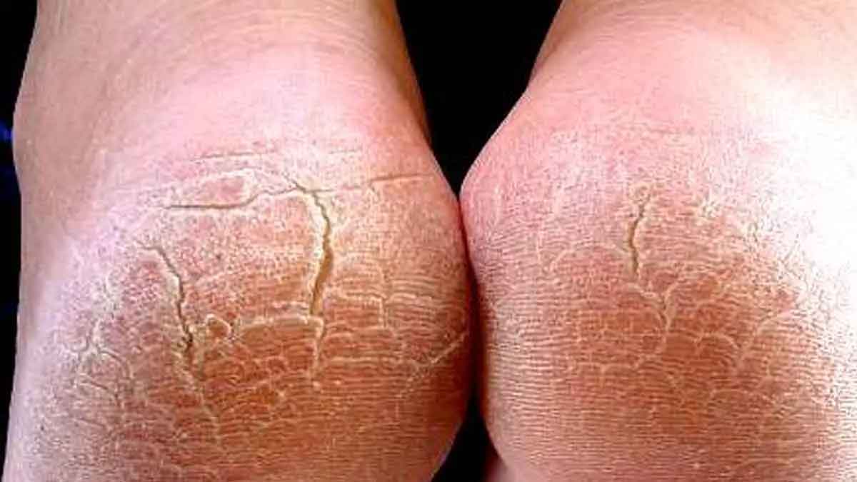 cracked heels wonderful home remedies 