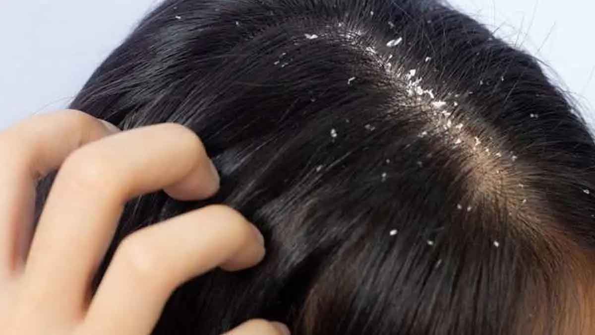 these natural tips will reduce dandruff 