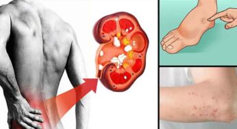 Kidney Problems : కిడ్నీ స‌మ‌స్య‌లు ఉన్నాయా..? అయితే ఈ ఆహారాల విష‌యంలో జాగ్ర‌త్త‌..!