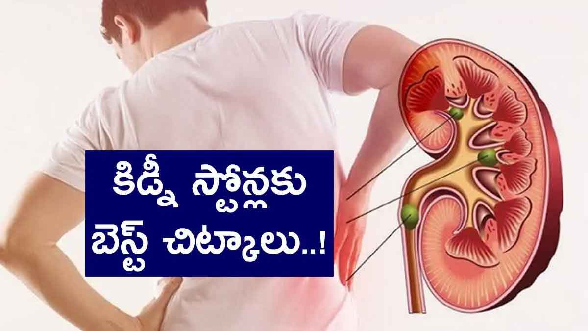 Best Remedies To Remove Kidney Stones 