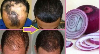 Onion For Hair Growth : ఉల్లిపాయతో ఇలా చేస్తే.. జుట్టు అస్సలు రాలదు.. బాగా ఒత్తుగా పెరుగుతుంది..!