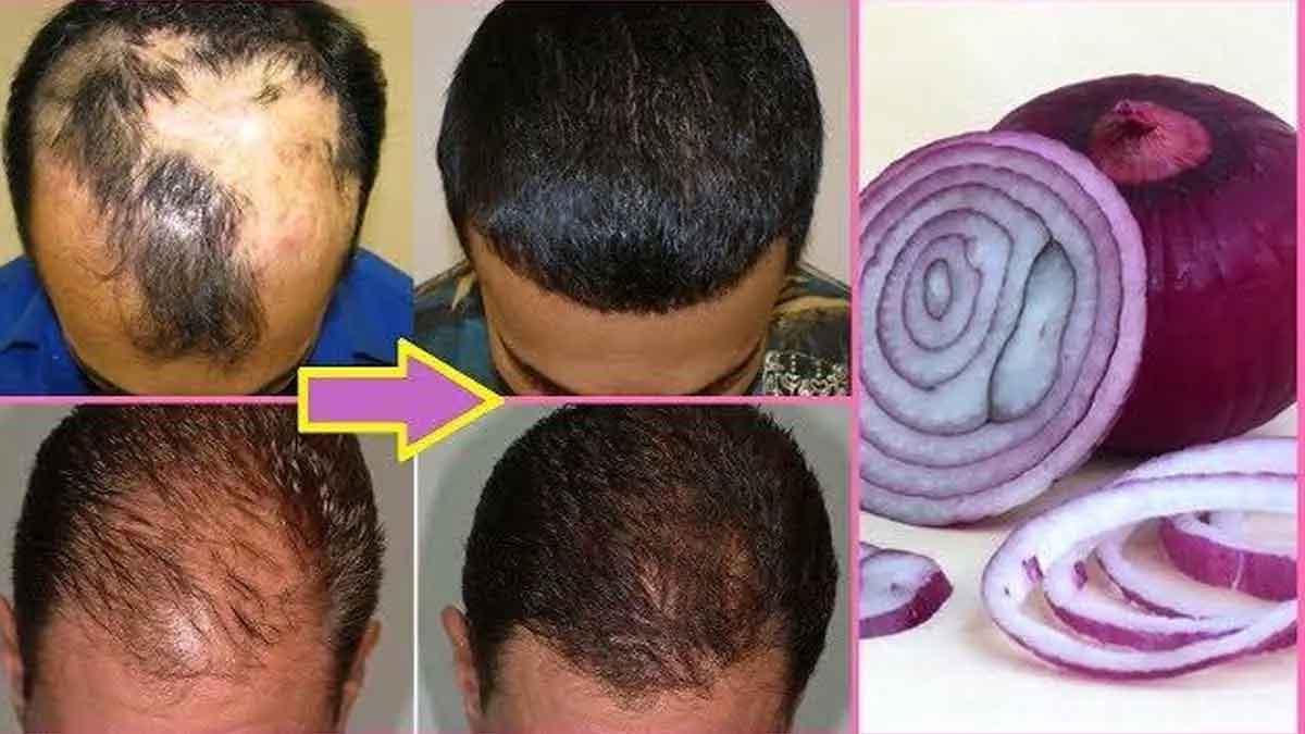 do like this with onions for hair growth 