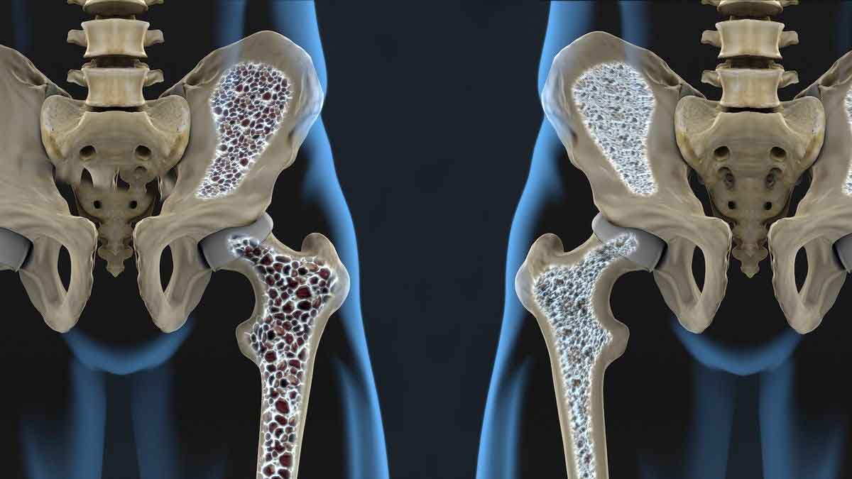 this is how osteoporosis comes 