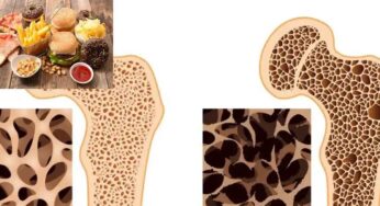 Osteoporosis : ఈ ఫుడ్స్‌ను తింటున్నారా.. అయితే జాగ్ర‌త్త‌.. మీ ఎముక‌లు బ‌ల‌హీనంగా మారిపోతాయి..!