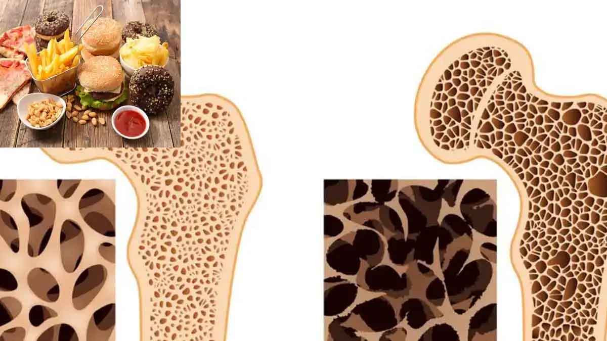 if you take these foods Osteoporosis will come 