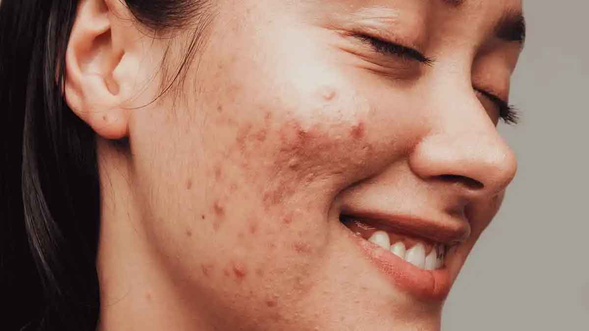 pimples home remedies must follow them for result 