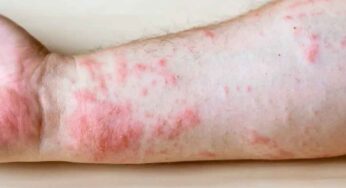 Skin Rashes : ఈ చ‌ర్మ స‌మ‌స్య‌లు మీకు ఉన్నాయా.. అయితే కార‌ణాలు ఏమిటో తెలుసుకోండి..!