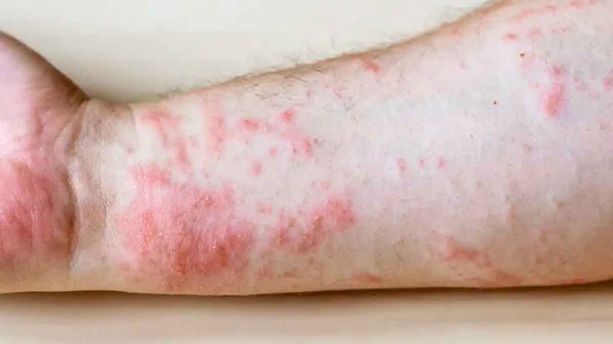 if you have skin rashes then know the reasons 