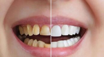 Teeth Whitening : గార ప‌ట్టిన దంతాల‌ను సైతం తెల్ల‌గా మార్చ‌గ‌ల‌దు.. ఇలా చేయాలి..!