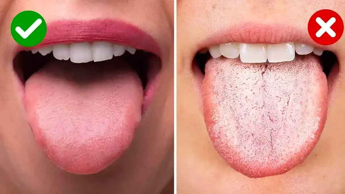 if your tongue is white then know what happens 