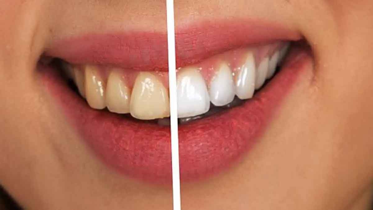 follow these natural tips to whiten your teeth 