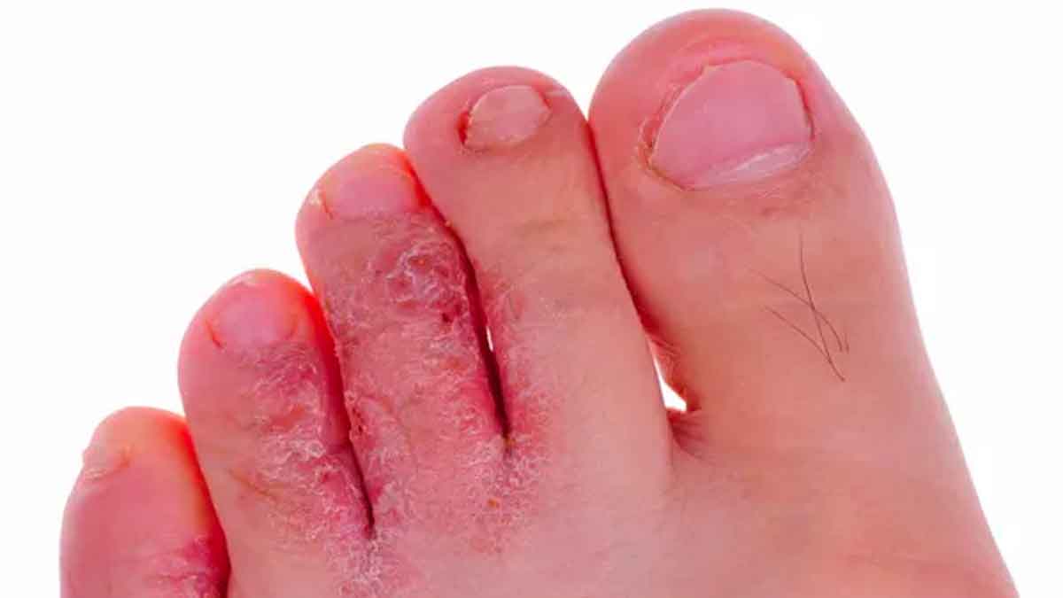 do you know about athlete's foot and how it comes 