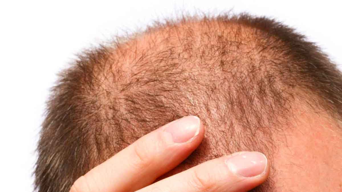 good news to bald head persons