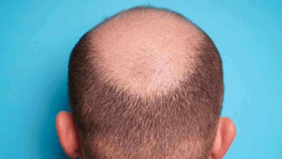 bald head people are more intelligent 