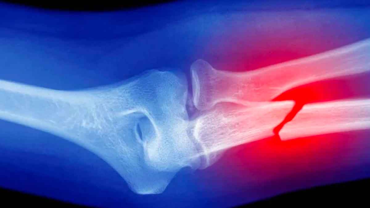 take these foods to heal broken bones quickly 