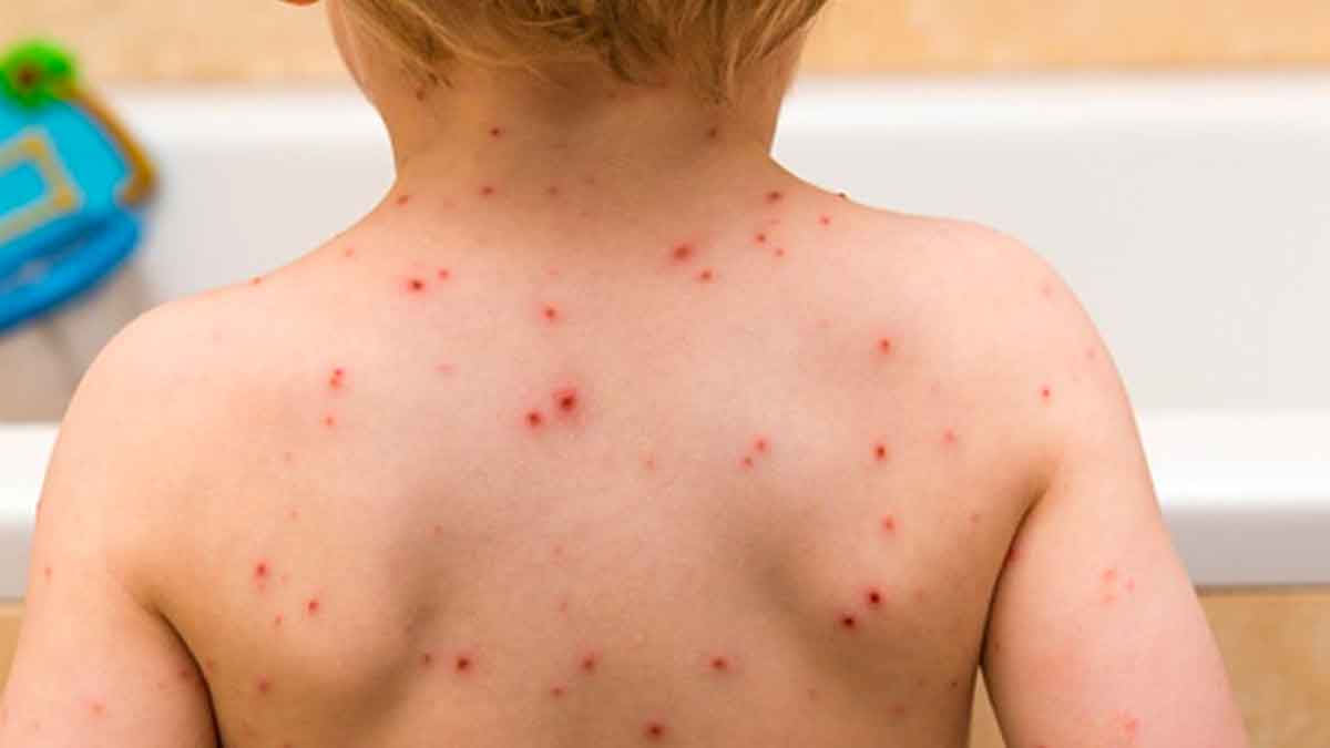 why chicken pox is called atalamma 