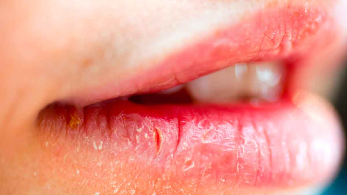 wonderful home remedies to get rid of cracked lips 