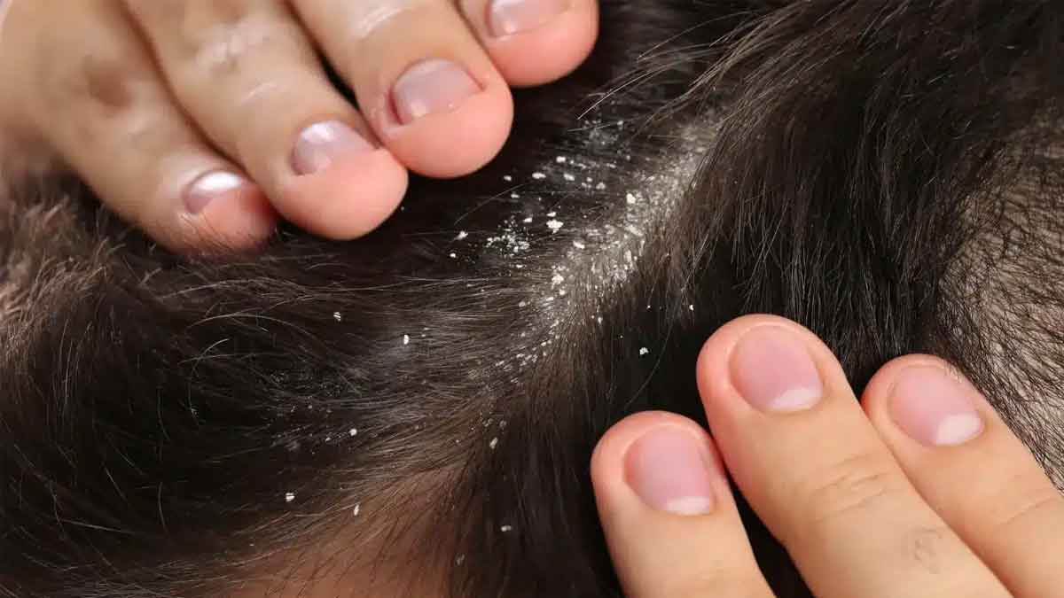 many wonderful home remedies how to reduce dandruff