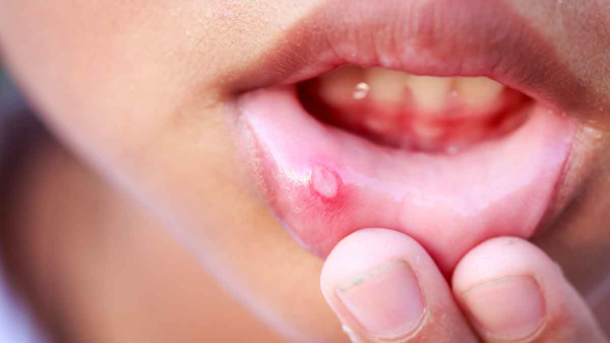 if you are suffering from mouth ulcer then follow these remedies 