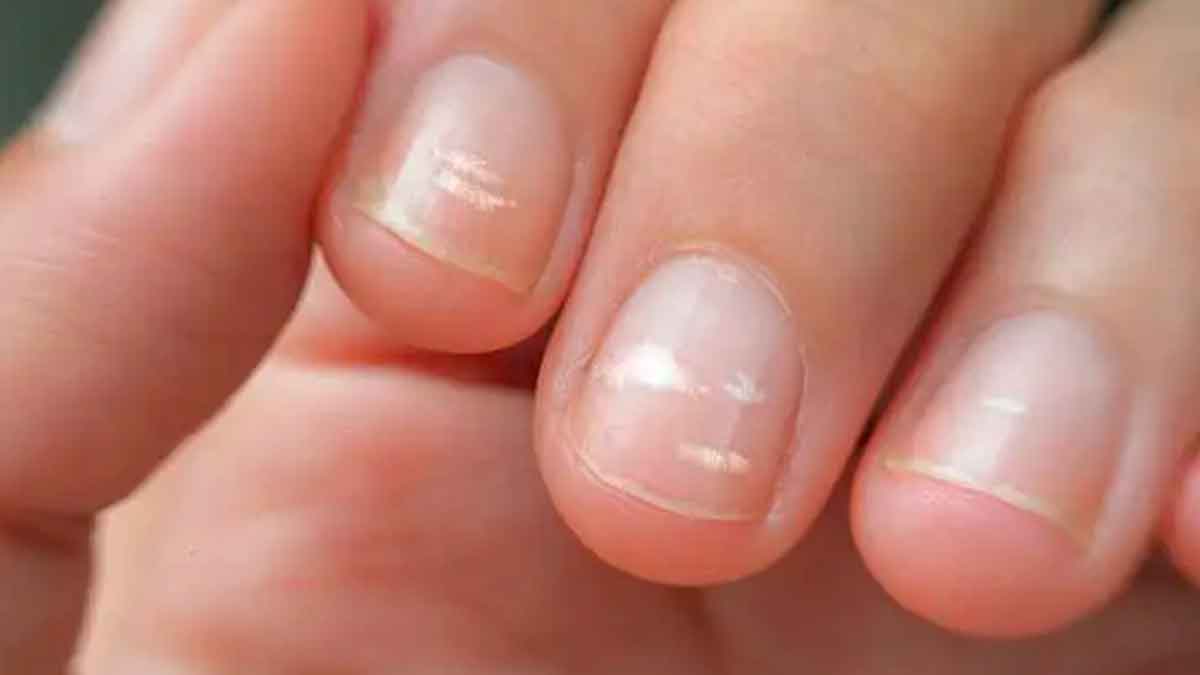 if you have white marks on nails then know what happens 