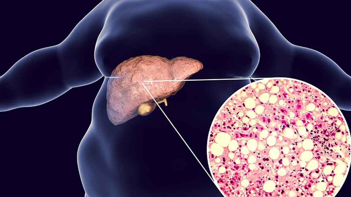 non alcoholic fatty liver disease symptoms and causes and treatment 