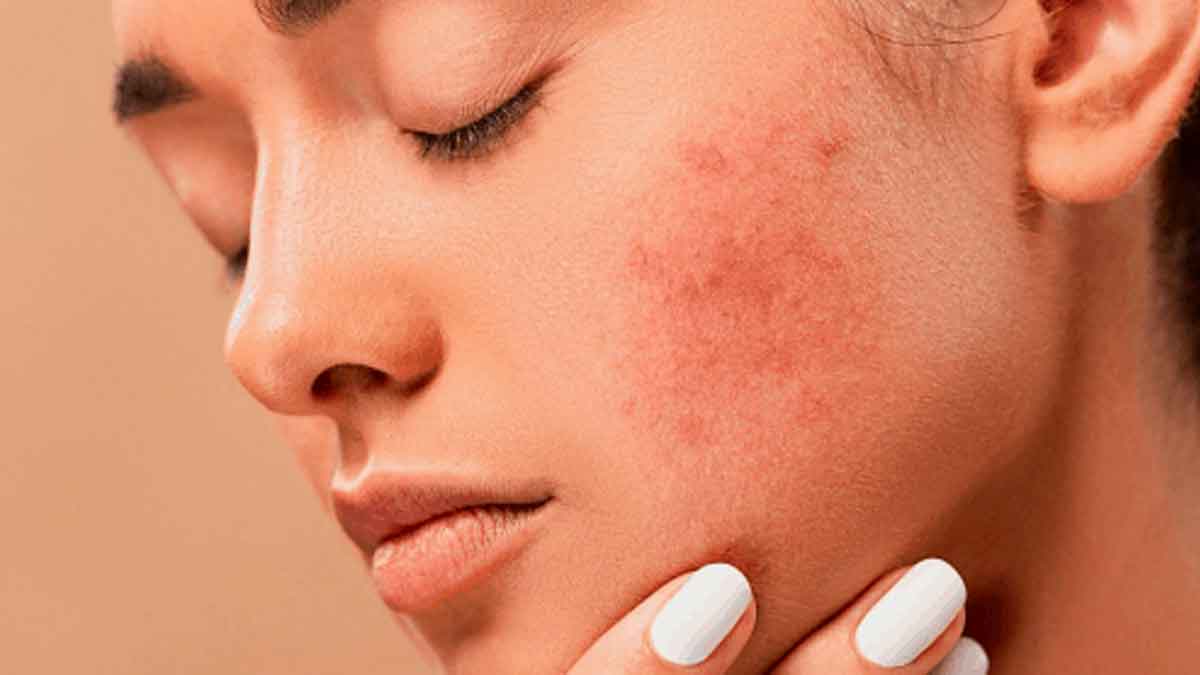 if you have these skin problems then these vitamins might be low 