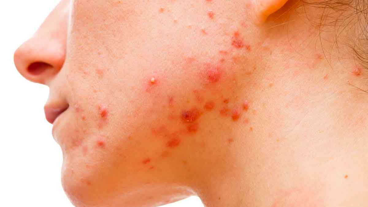 follow these tips if you have acne 