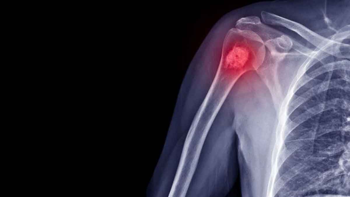 if you have these symptoms then it might be bone cancer 