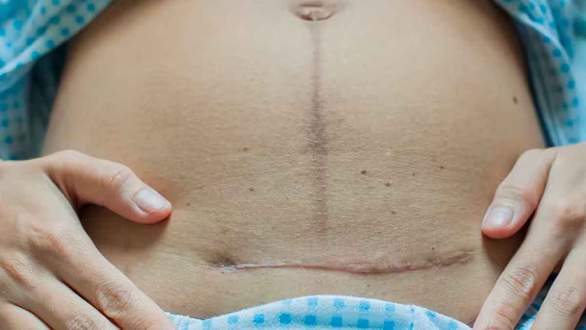 women who got cesarean must follow these tips 