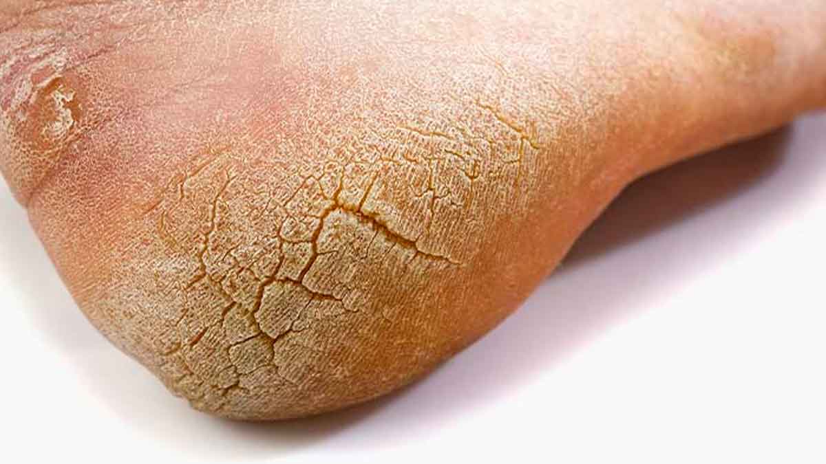 if you are facing cracked heels problem follow these remedies 