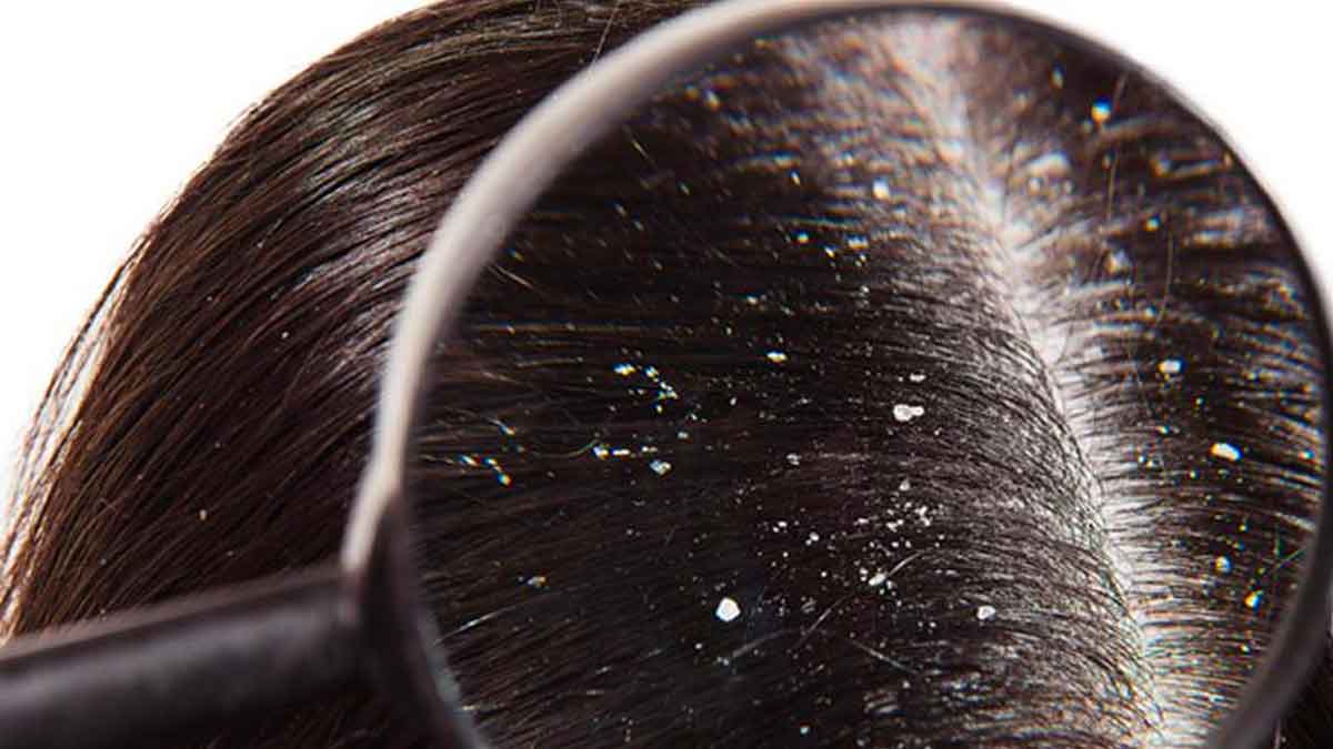 follow these wonderful home remedies to reduce dandruff 