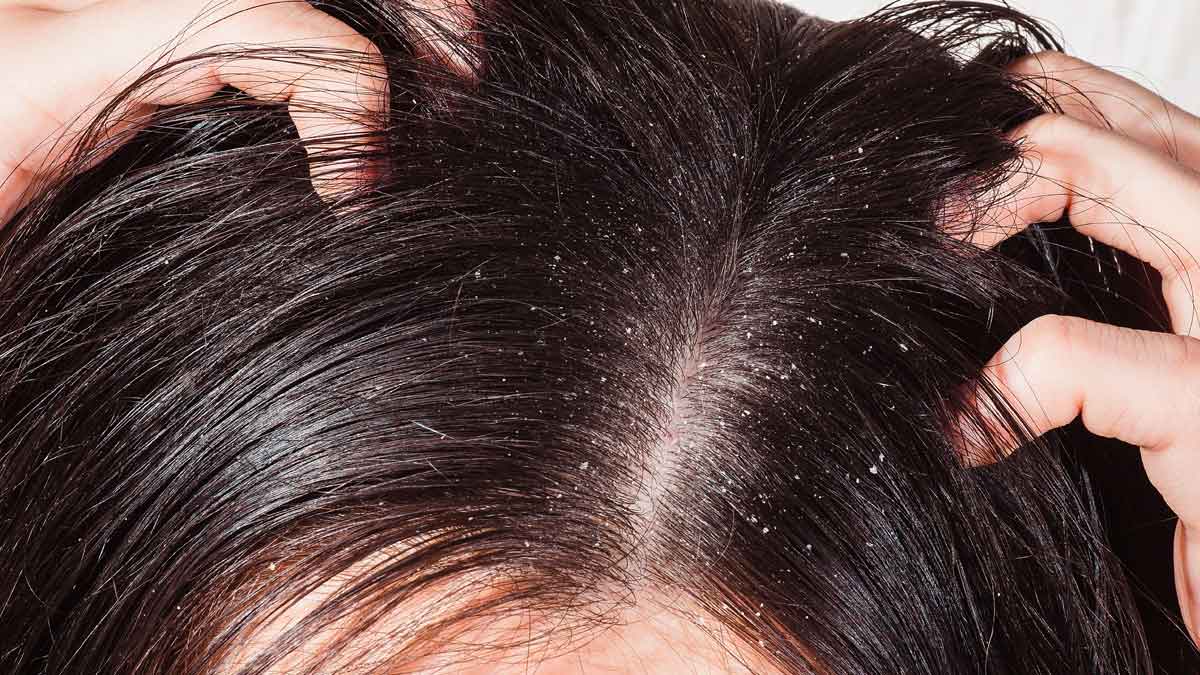 how to reduce dandruff 