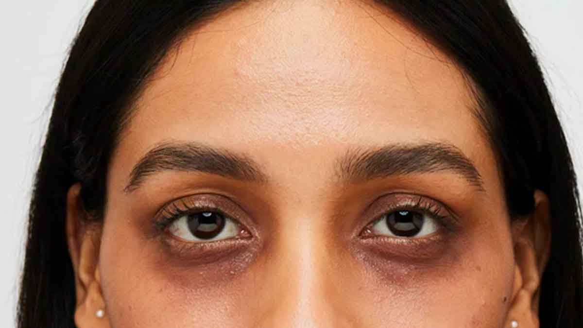 follow these home remedies to reduce dark circles 