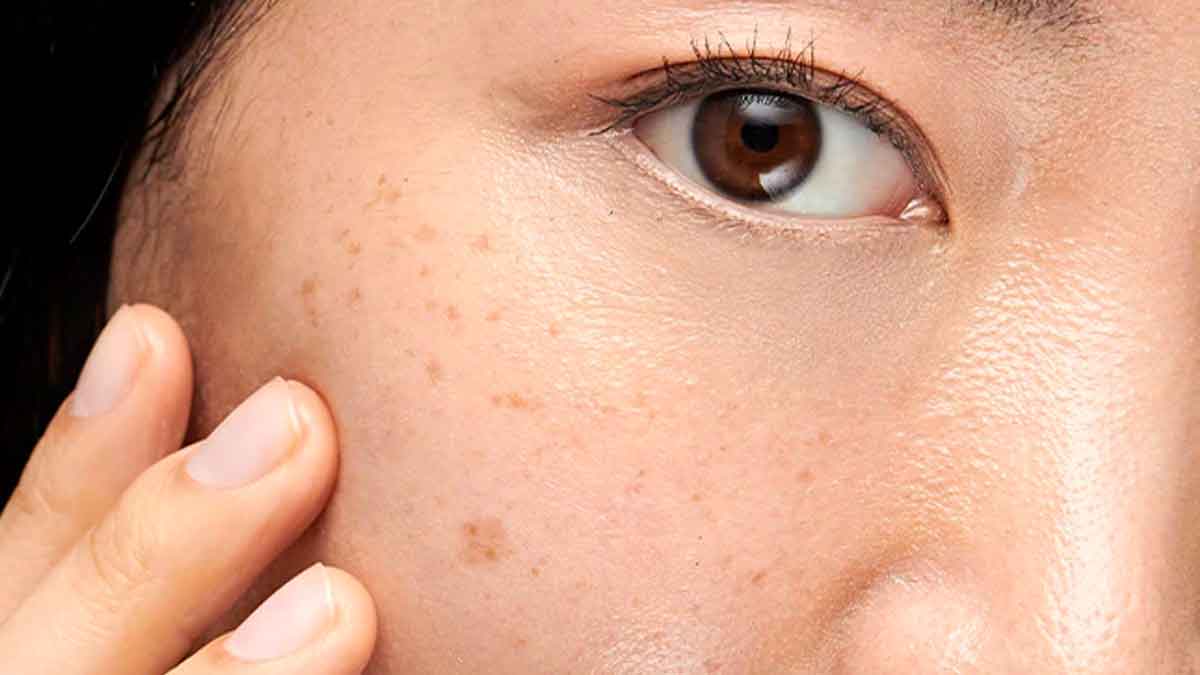 follow these wonderful home remedies to remove dark spots 