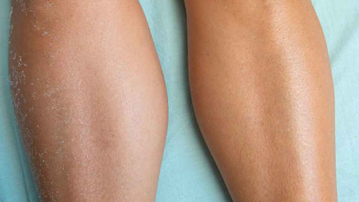 follow these wonderful home remedies if you have dry legs 