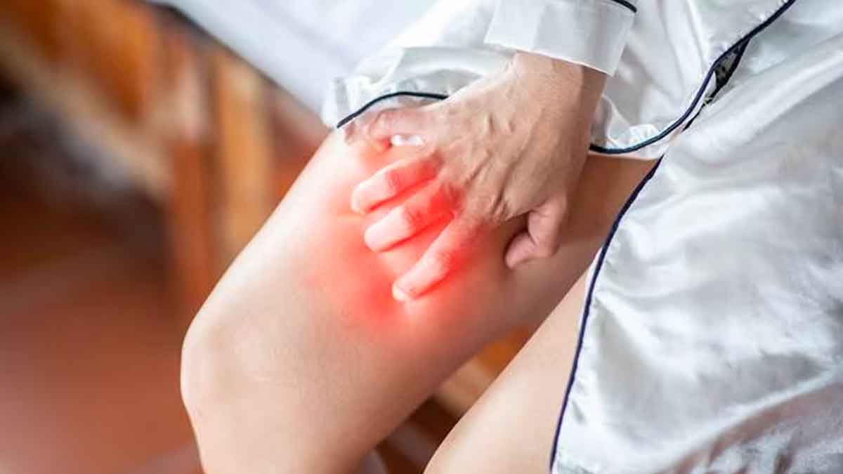 follow these home remedies to reduce itchy thighs 