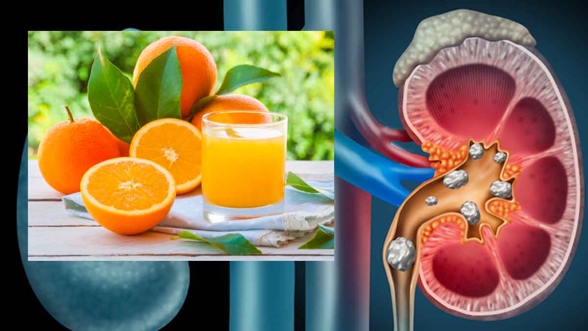 drinking orange juice daily can prevent kidney stones 