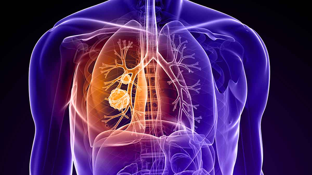 how lung cancer spreads must know about it 