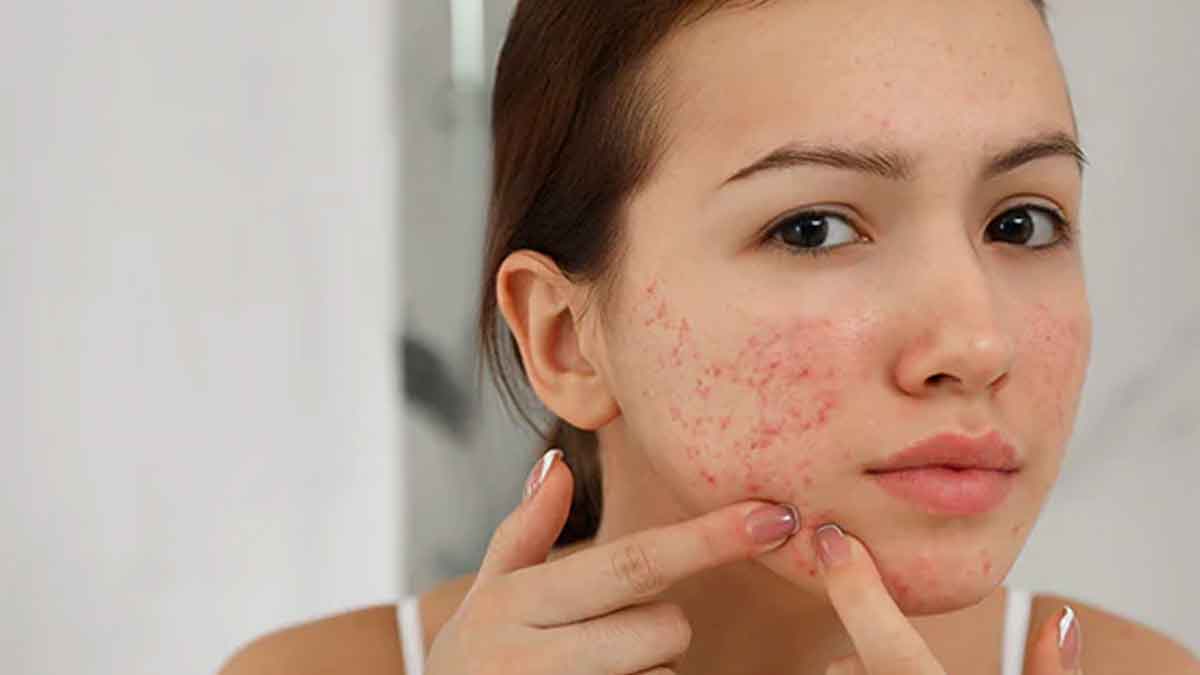 follow these wonderful home remedies to get rid of pimples 