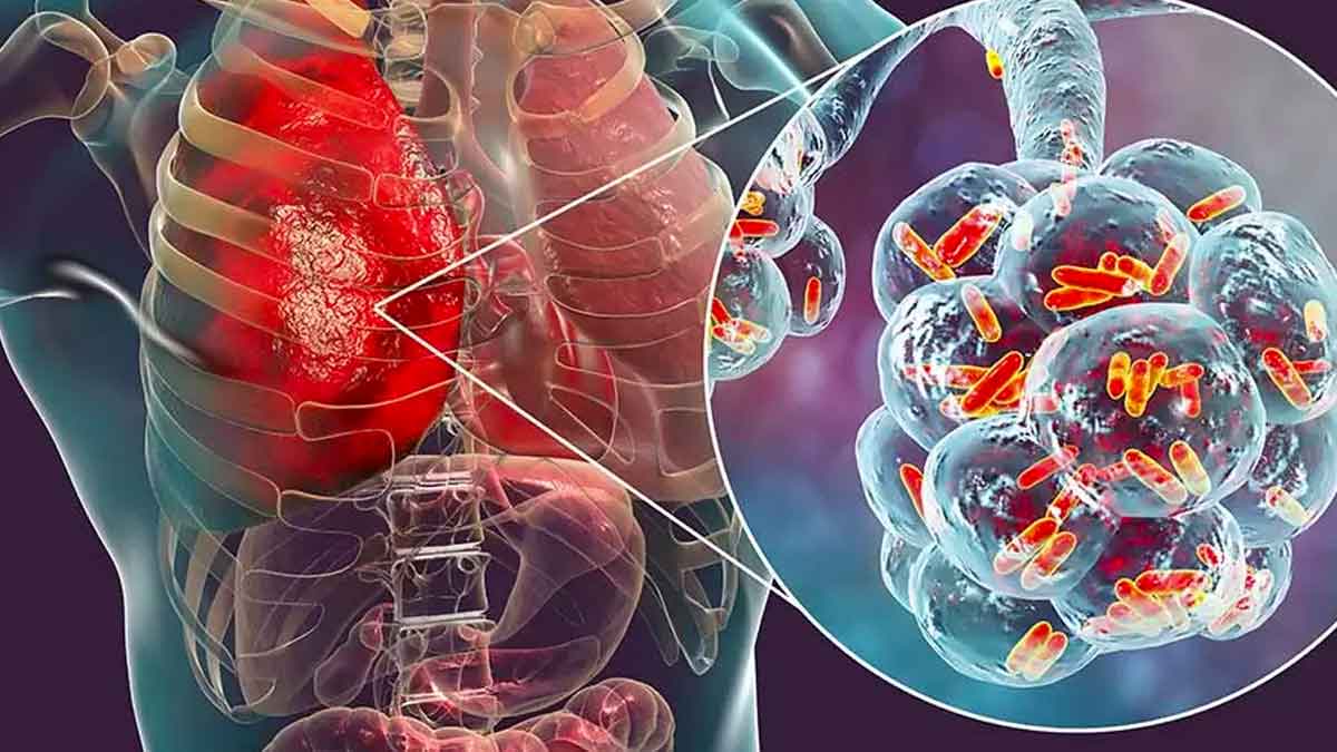 every one must know this about pneumonia