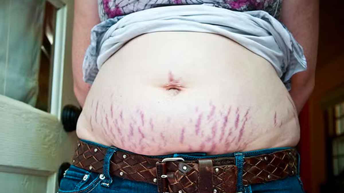 women follow these remedies to remove stretch marks 